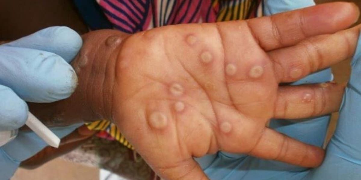 Hamilton hosting proactive pop-up monkeypox vaccination clinic this week